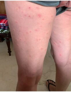 PACK TRATAMIENTO ANTI ÁCAROS DEL POLVO -Plagasonline Ventas pack tratamiento anti acaros 1 habitacion 2